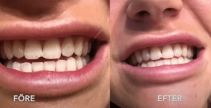 iWhite tandblekning med startkit - före och efterbild.